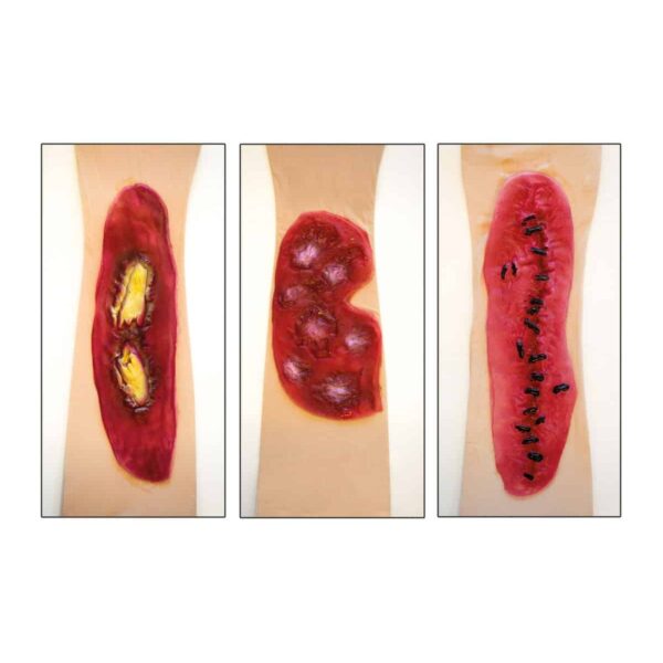 Protesi in Lattice Ferite Infette Assortite